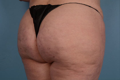 Cellulite Reduction Before & After Image