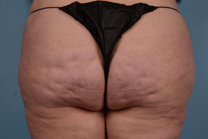 Cellulite Reduction Before & After Image