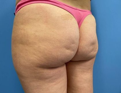 Cellulite Reduction Before & After Image