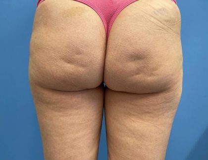 Cellulite Reduction Before & After Image