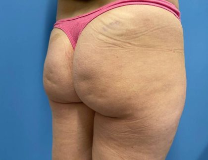 Cellulite Reduction Before & After Image