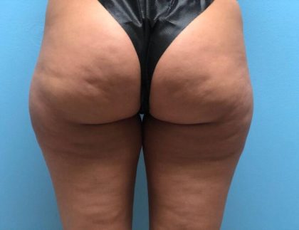 Cellulite Reduction Before & After Image