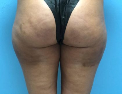 Cellulite Reduction Before & After Image