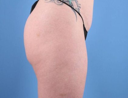 Cellulite Reduction Before & After Image