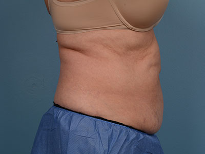 CoolSculpting® Before & After Image