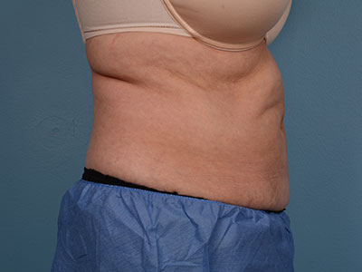 CoolSculpting® Before & After Image