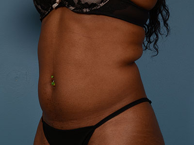 CoolSculpting® Before & After Image