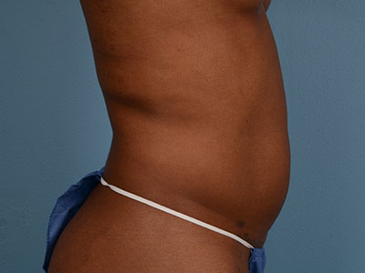 CoolSculpting® Before & After Image