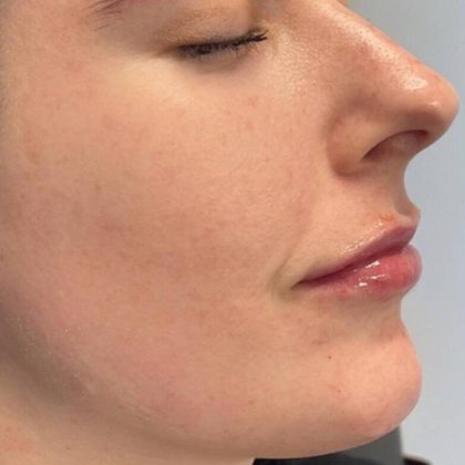 Lip Fillers Before & After Image