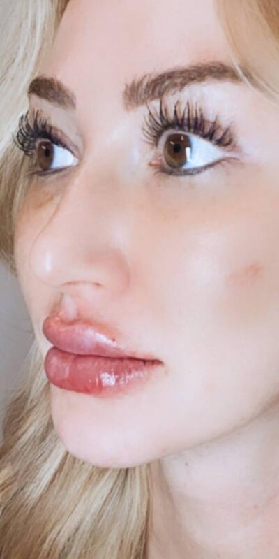 Lip Fillers Before & After Image