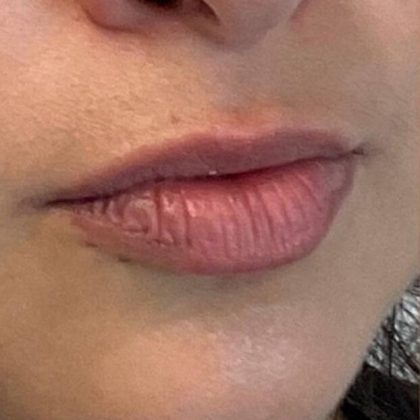 Lip Fillers Before & After Image