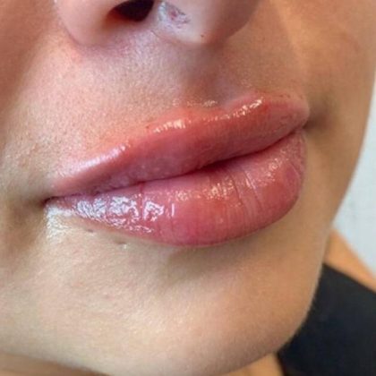 Lip Fillers Before & After Image