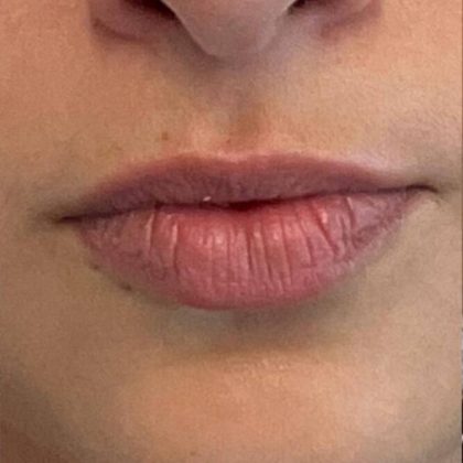 Lip Fillers Before & After Image