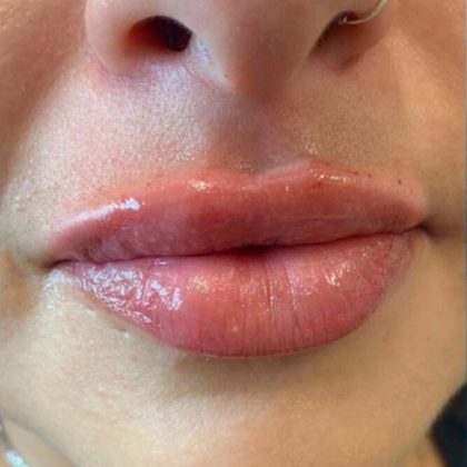 Lip Fillers Before & After Image