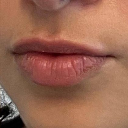 Lip Fillers Before & After Image