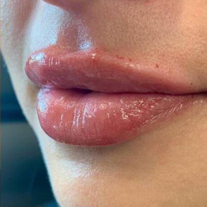 Lip Fillers Before & After Image