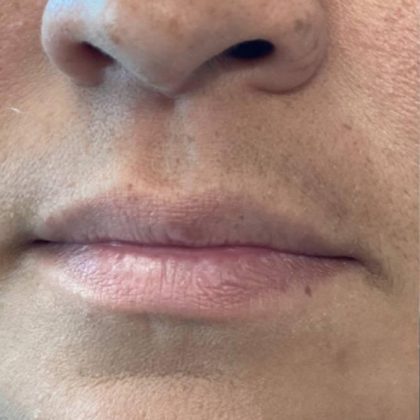 Lip Fillers Before & After Image