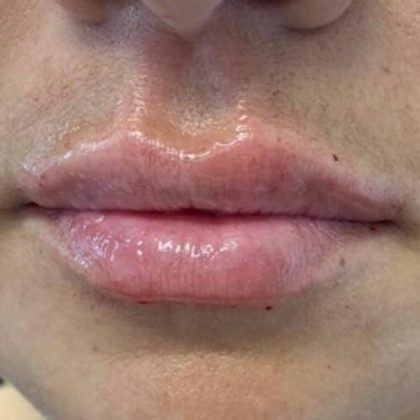 Lip Fillers Before & After Image