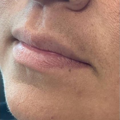 Lip Fillers Before & After Image