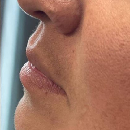 Lip Fillers Before & After Image