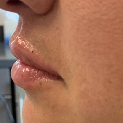 Lip Fillers Before & After Image