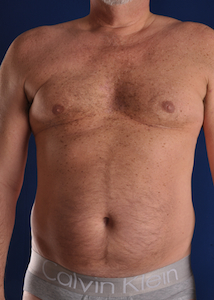Hi-Def Liposuction Before & After Patient #2257
