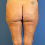 Vaser Liposuction Before & After Patient #5709