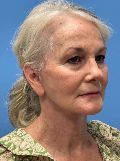Facelift Before & After Patient #8515