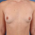 Breast Implant Replacement Before & After Patient #8899