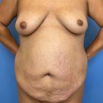 Breast Lift Before & After Patient #8886