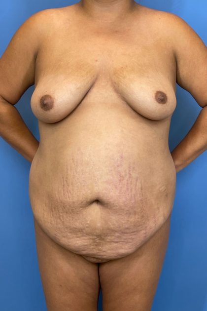 Breast Lift Before & After Patient #8886