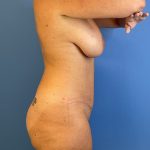 Breast Lift Before & After Patient #8877