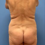 Brazilian Butt Lift(BBL) Before & After Patient #8926