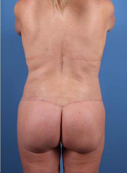 Brazilian Butt Lift(BBL) Before & After Patient #8926