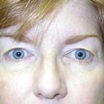 Eyelid Surgery Before & After Patient #2143