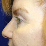 Eyelid Surgery Before & After Patient #2143