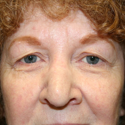 Eyelid Surgery Before & After Patient #2164