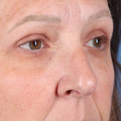 Eyelid Surgery Before & After Patient #6740