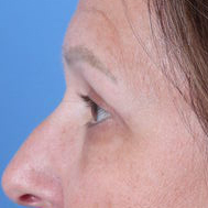 Eyelid Surgery Before & After Patient #6740