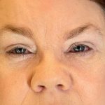 Eyelid Surgery Before & After Patient #8832