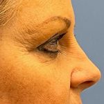 Eyelid Surgery Before & After Patient #8830